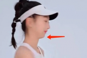 森碟下巴后缩改善显著，美丽蜕变令人惊叹！