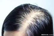 女子因脱发30岁被误认为奶奶，脱发困扰，年轻女性的隐形痛