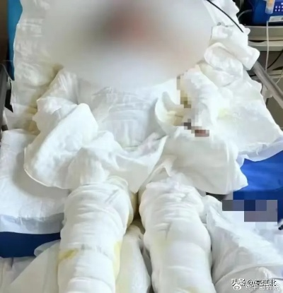 卡式炉爆炸事故致7人重伤，惨变木乃伊，悲剧背后的人性反思