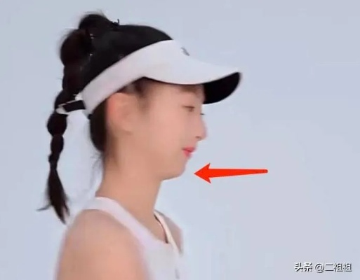 森碟下巴后缩改善显著，美丽蜕变令人惊叹！